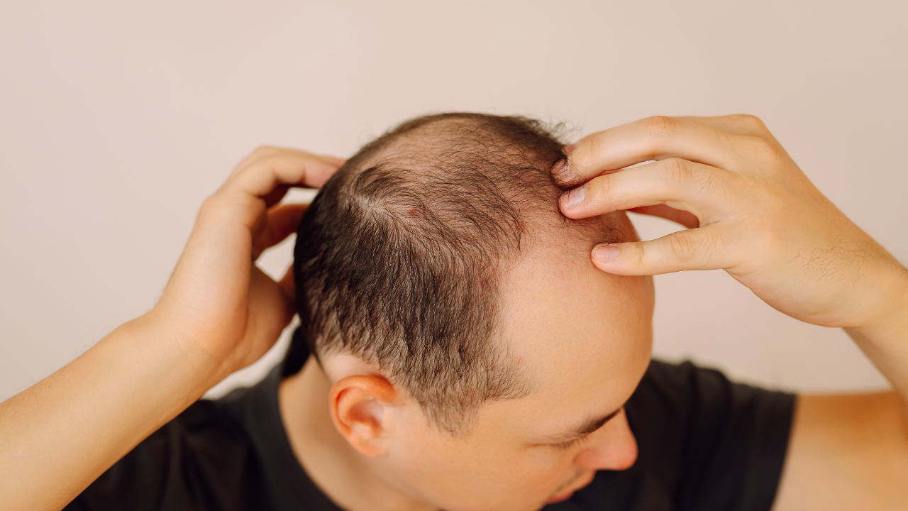 Calvitie chez l'homme : causes, stades et solutions